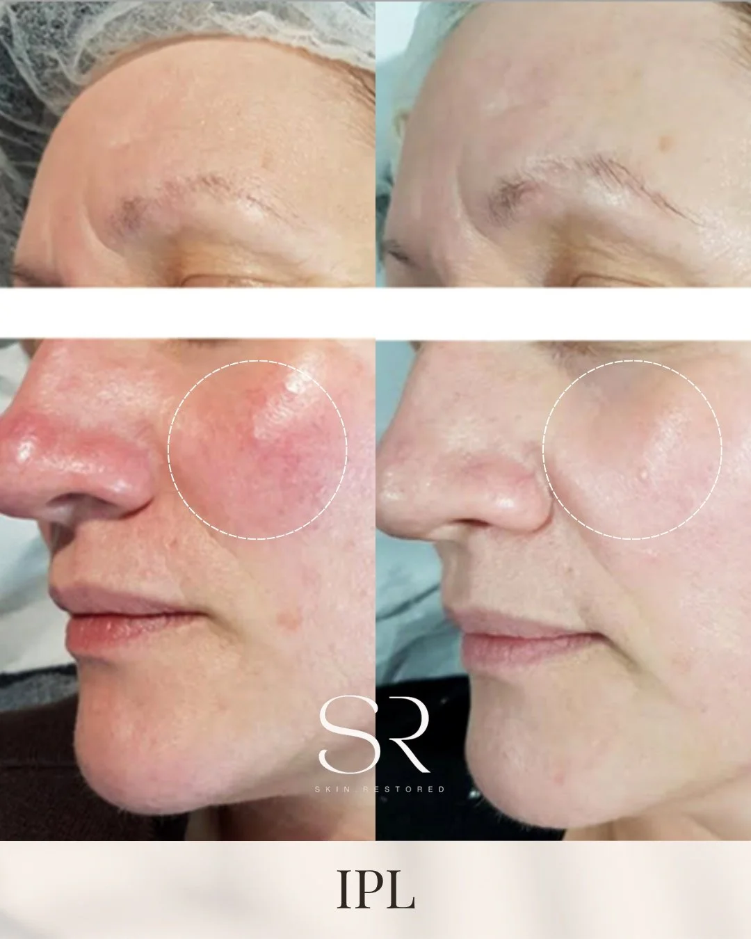 Clearer, smoother skin with IPL! 🌟
As the weather gets hotter, it's the perfect time to target redness, pigmentation, and sun spots with IPL. After just one session, you'll have a refreshed, even complexion, and glowing skin ready for summer. Say go