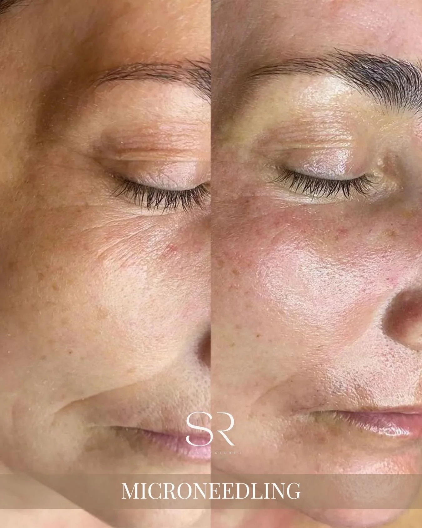 Be honest&hellip; how many products have you tried hoping your skin would finally smooth out?

And it kinda helps&hellip; but not really.

That&rsquo;s because most skincare only works on the surface.

If your texture, pores, or acne scars aren&rsquo