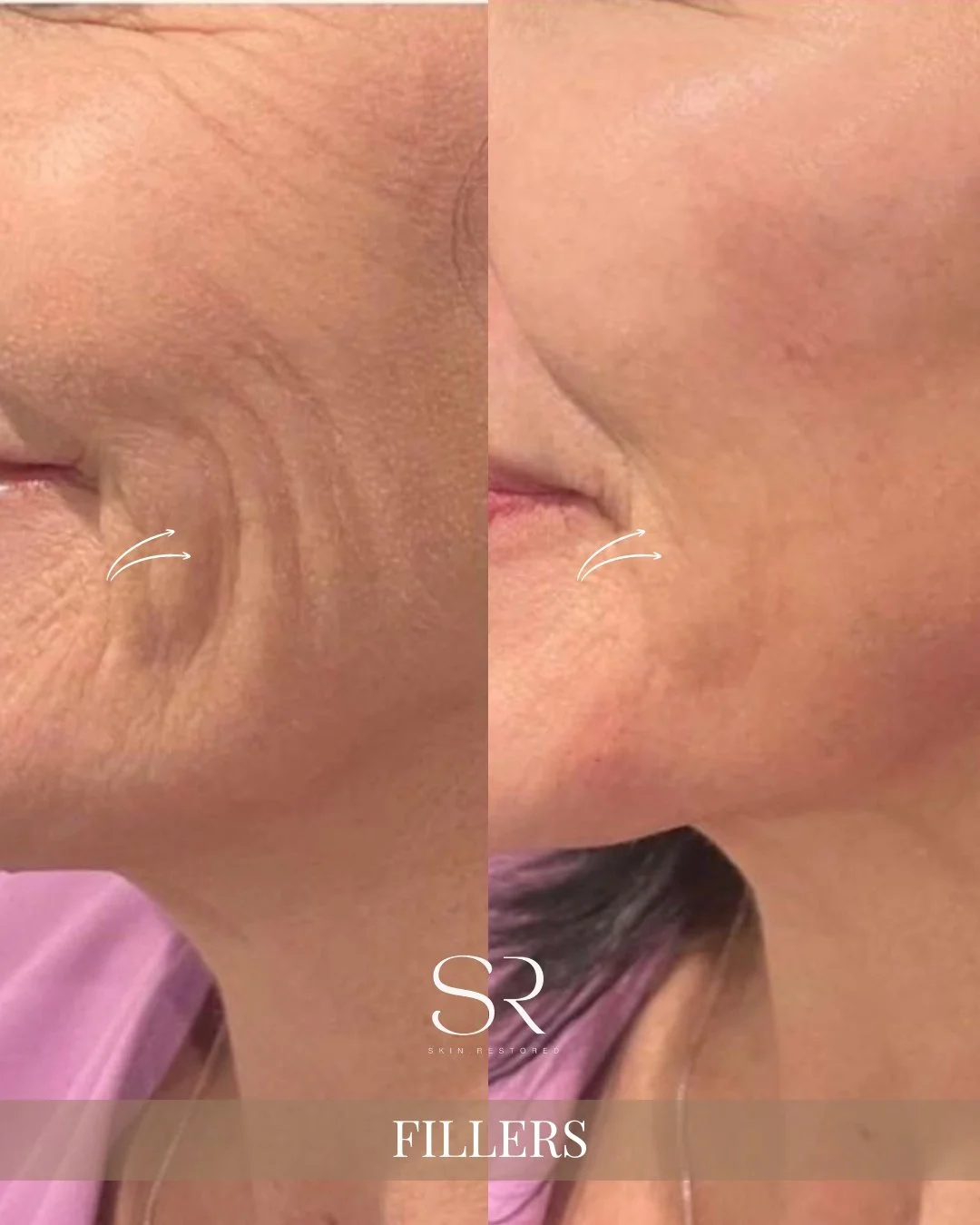 Not all wrinkles need to be &ldquo;filled&rdquo; but the right ones do ✨

Those deeper smile lines? They&rsquo;re often caused by volume loss over time, not just skin texture. That&rsquo;s where fillers come in.

Done correctly, fillers don&rsquo;t m