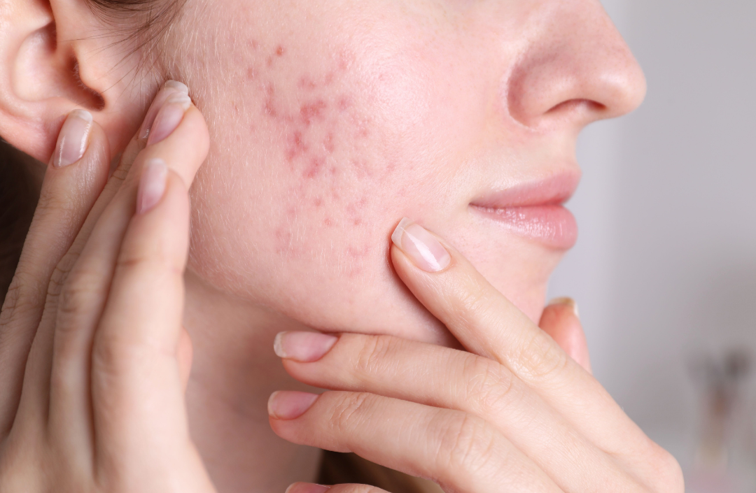 How to Treat Acne Scars: Expert-Recommended Solutions