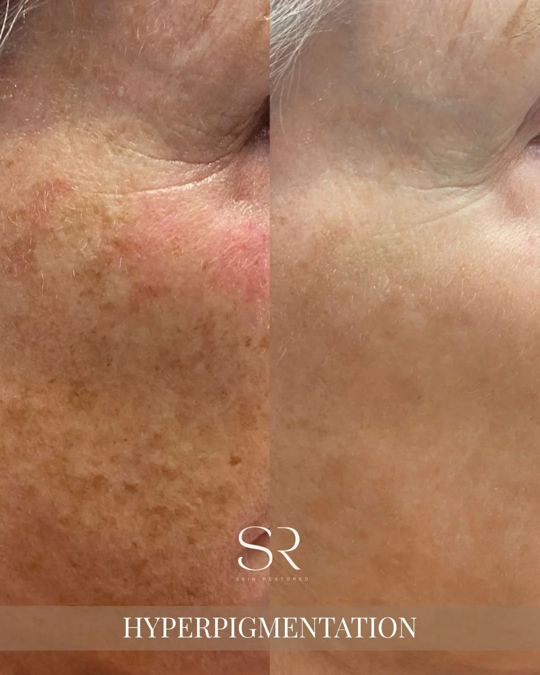 Hyperpigmentation isn&rsquo;t just &ldquo;a skin issue&rdquo;&hellip; it&rsquo;s the one thing that makes your skin look uneven no matter how good everything else is.
Dark spots. Sun damage. Acne marks that just won&rsquo;t fade.

You try products, w