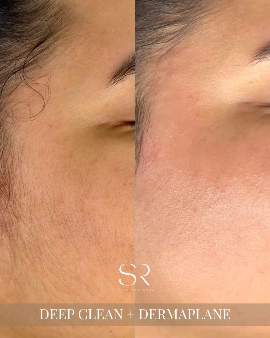 That fresh, smooth, glass-skin glow hits different after a Deep Clean + Dermaplane. ✨

Removing dead skin buildup and peach fuzz instantly helps your skin look brighter, smoother, and makeup-ready. This treatment is perfect before events or anytime y