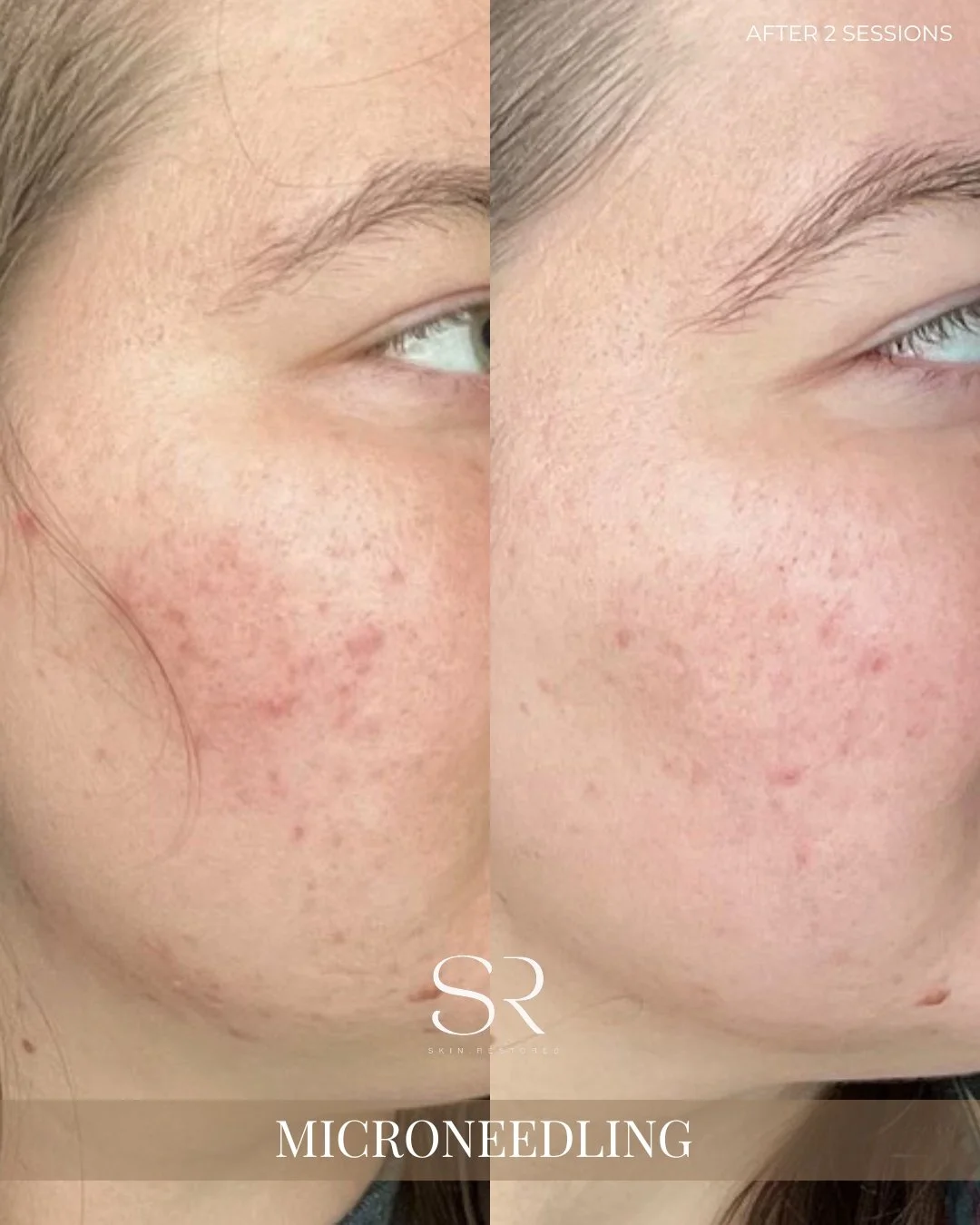 Acne scars don&rsquo;t disappear overnight&hellip; but your skin can start rebuilding itself. ✨

After just 2 sessions of Microneedling, you can already see smoother texture, softer acne scarring, and calmer-looking skin. This treatment works by stim
