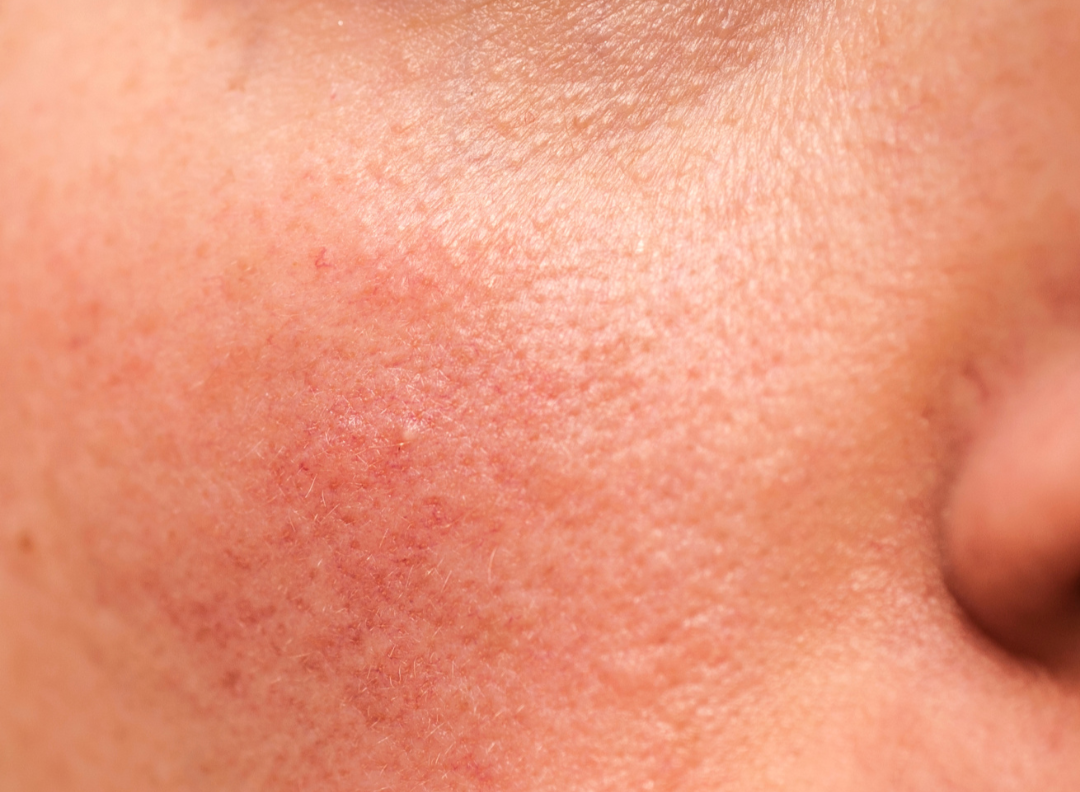 How to Repair Sun-Damaged Skin After Summer