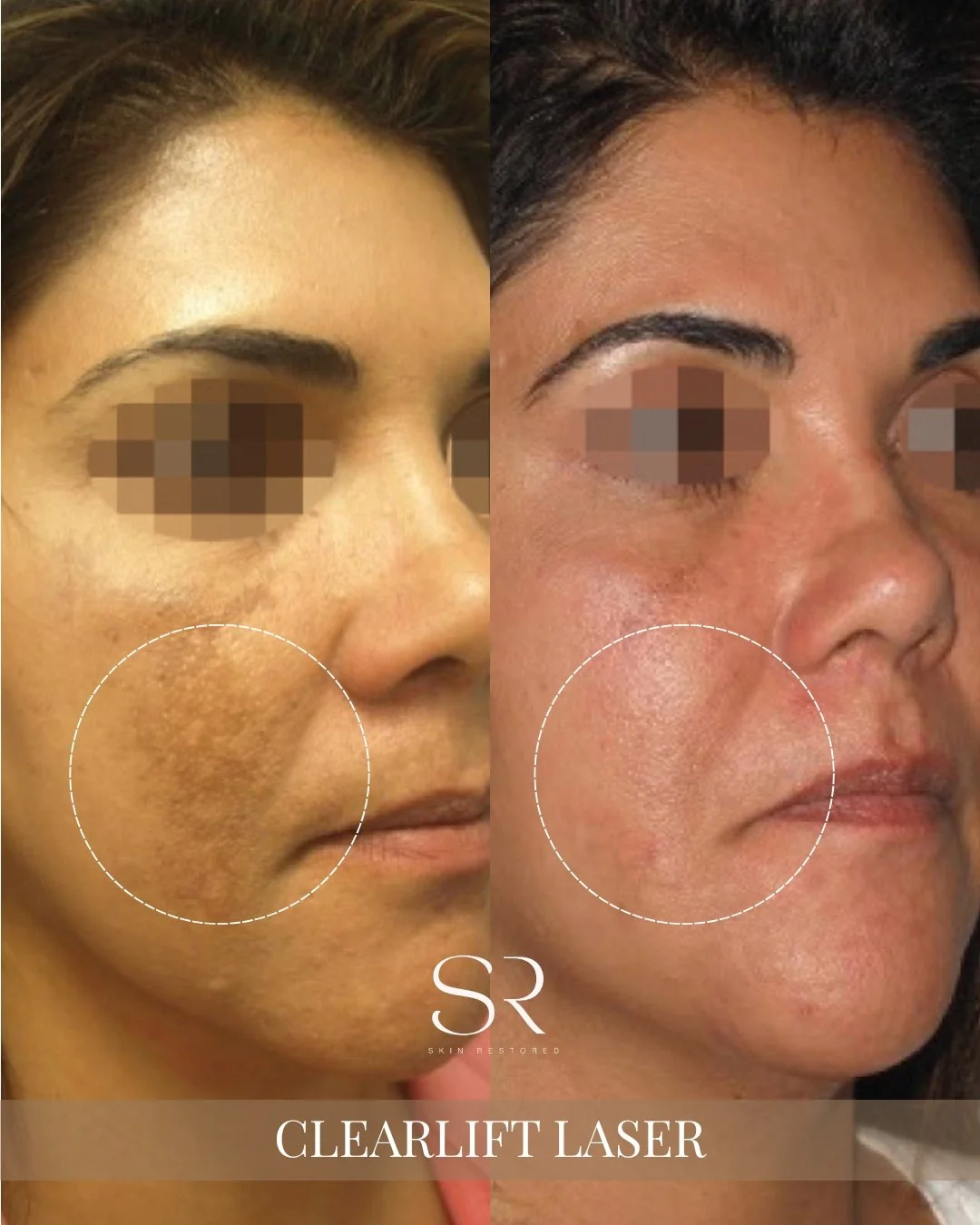 Sun damage, pigmentation, uneven skin tone&hellip; this is your sign to stop covering it and start treating it. ✨

This Clearlift Laser transformation shows brighter, smoother, healthier-looking skin with reduced pigmentation and improved texture. On