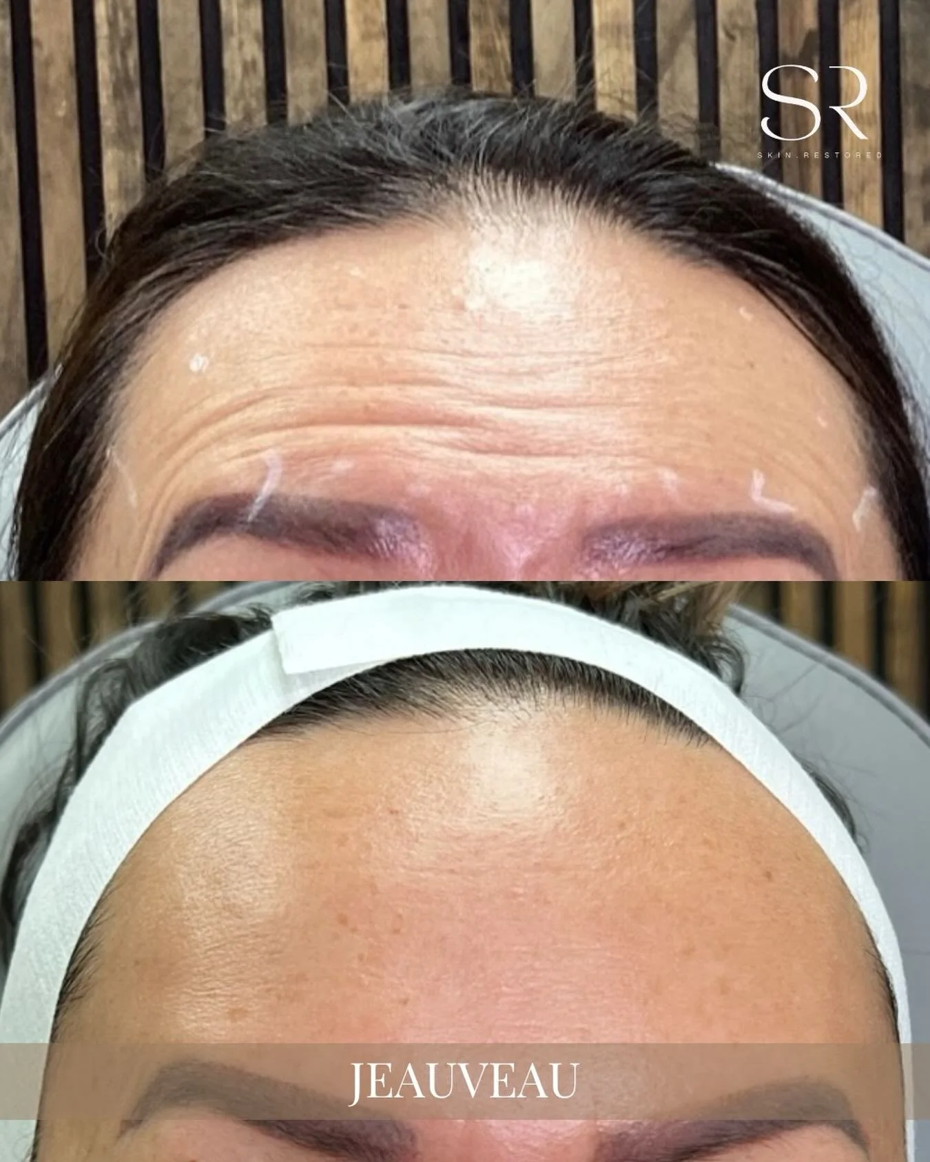 Smooth out those worry lines and restore a refreshed, natural look. ✨

This Jeauveau treatment softens forehead lines and expression wrinkles, giving you a refreshed, balanced appearance while keeping your natural expressions intact. One session can 