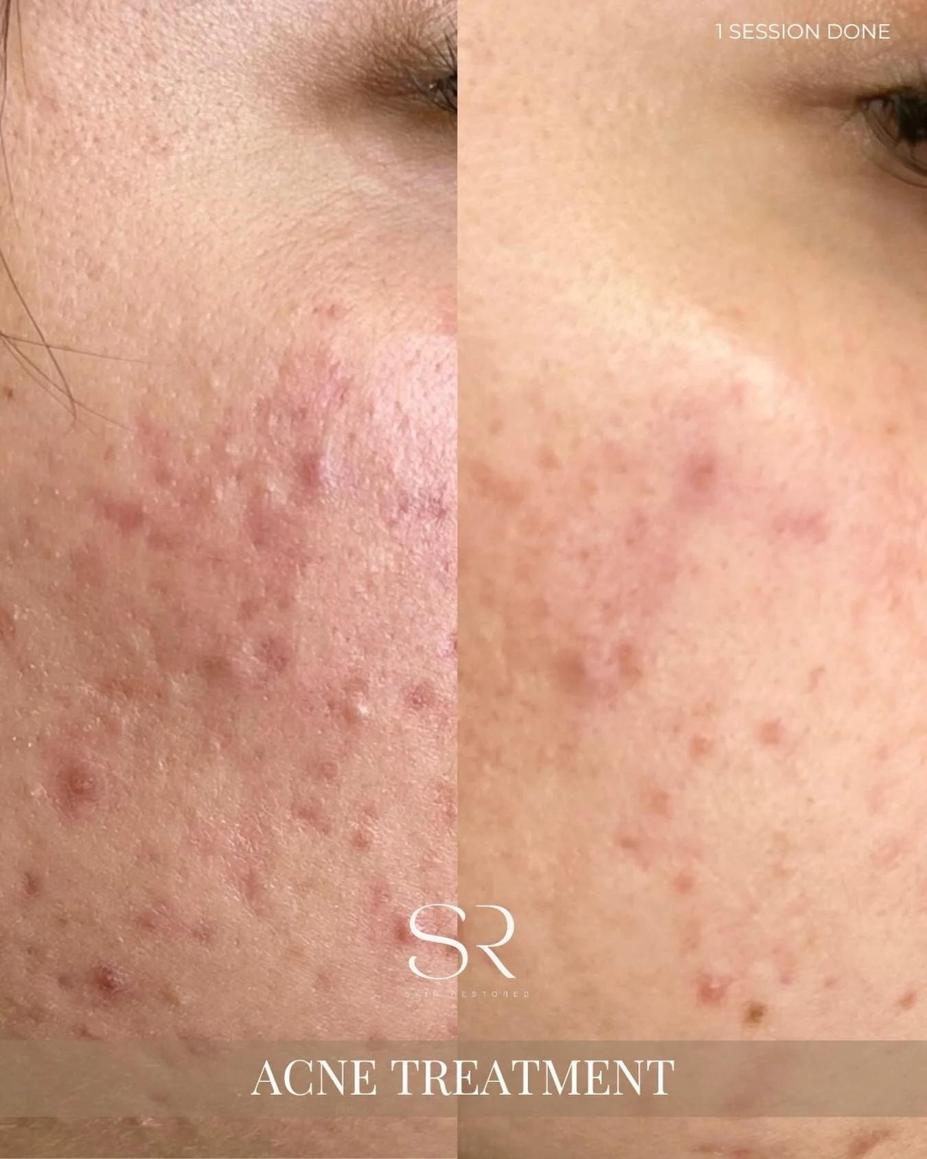 Breakouts don&rsquo;t have to define your skin. 🌟

After just 1 session, you can already see a reduction in redness and inflammation. Our Acne Treatment targets active acne, promotes healing, and prevents future breakouts for clearer, calmer skin.

