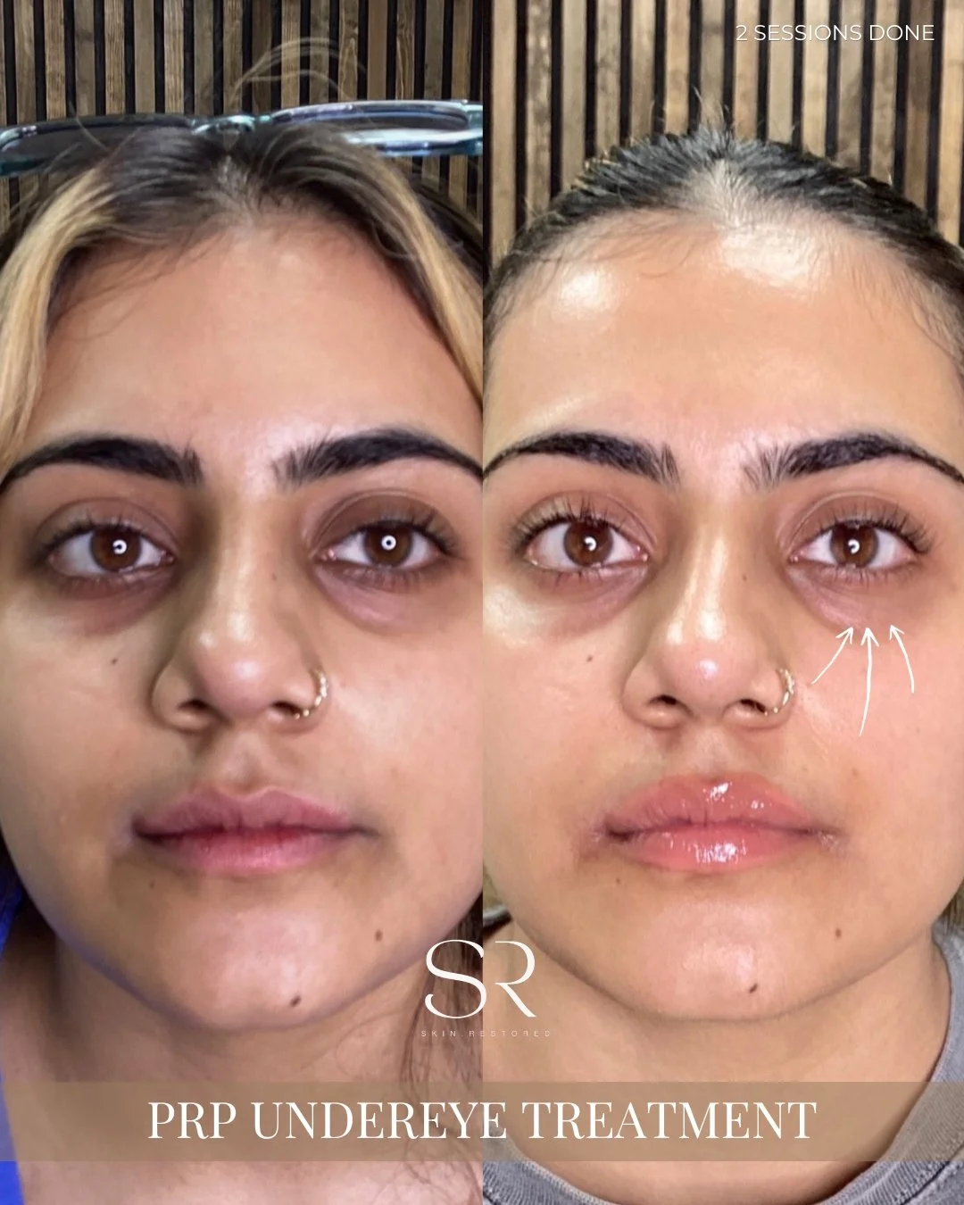 Tired of dark circles, hollows, or fine lines making you look exhausted?

PRP Undereye Treatment helps restore volume, smooth fine lines, and brighten your under-eye area using your body&rsquo;s own growth factors. After just 2 sessions, you can see 