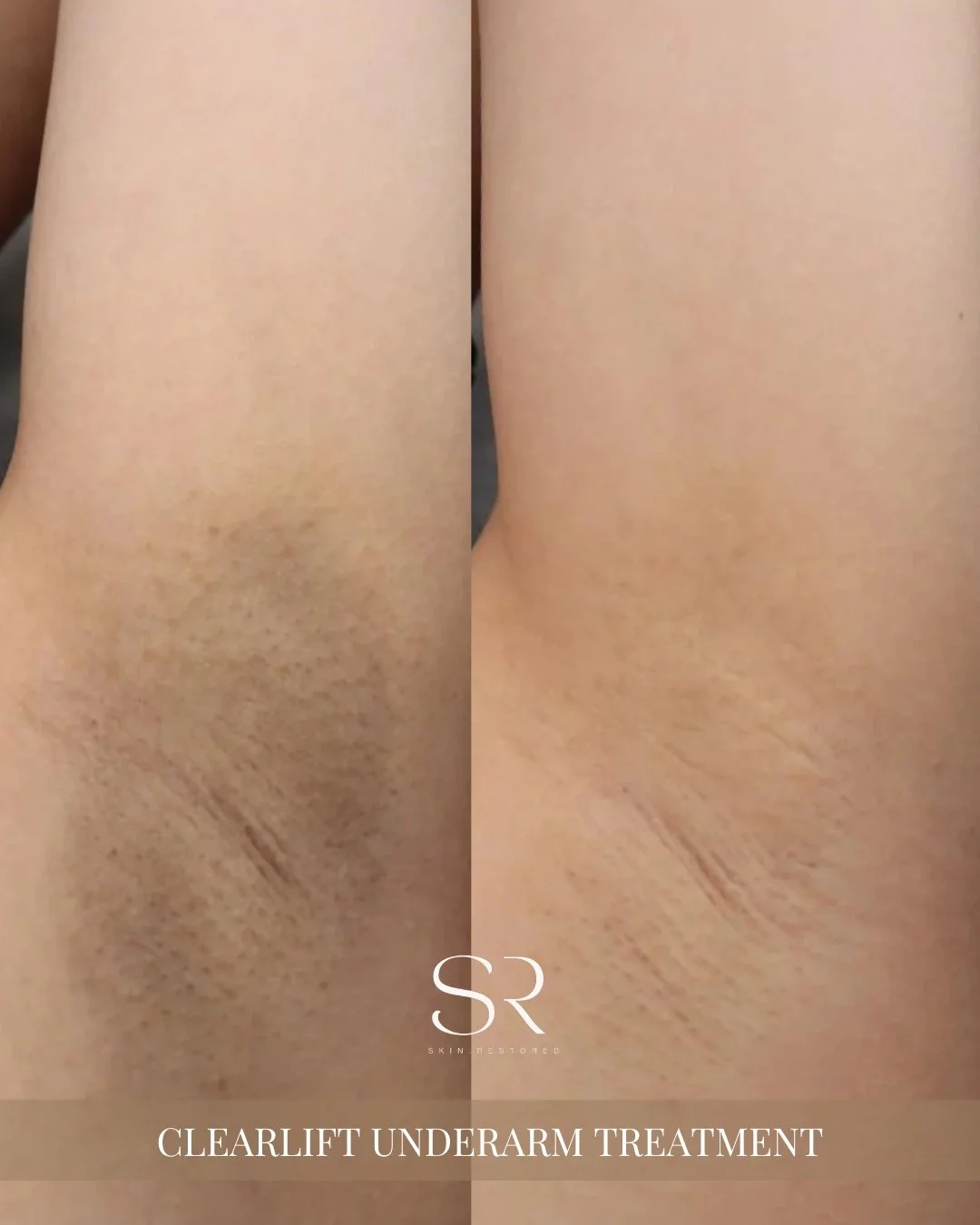 Say goodbye to uneven tone and hello to smooth, refreshed skin! ✨

Our Clearlift Treatment gently targets pigmentation, sun damage, and texture concerns for a healthier, brighter look. Minimal downtime, maximum results. Your skin&rsquo;s glow is just
