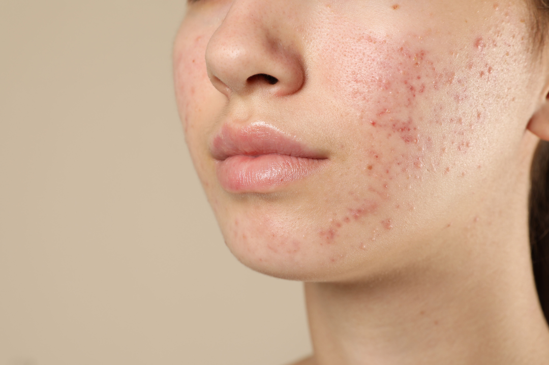 Why Your Acne Keeps Coming Back — And How to Prevent It