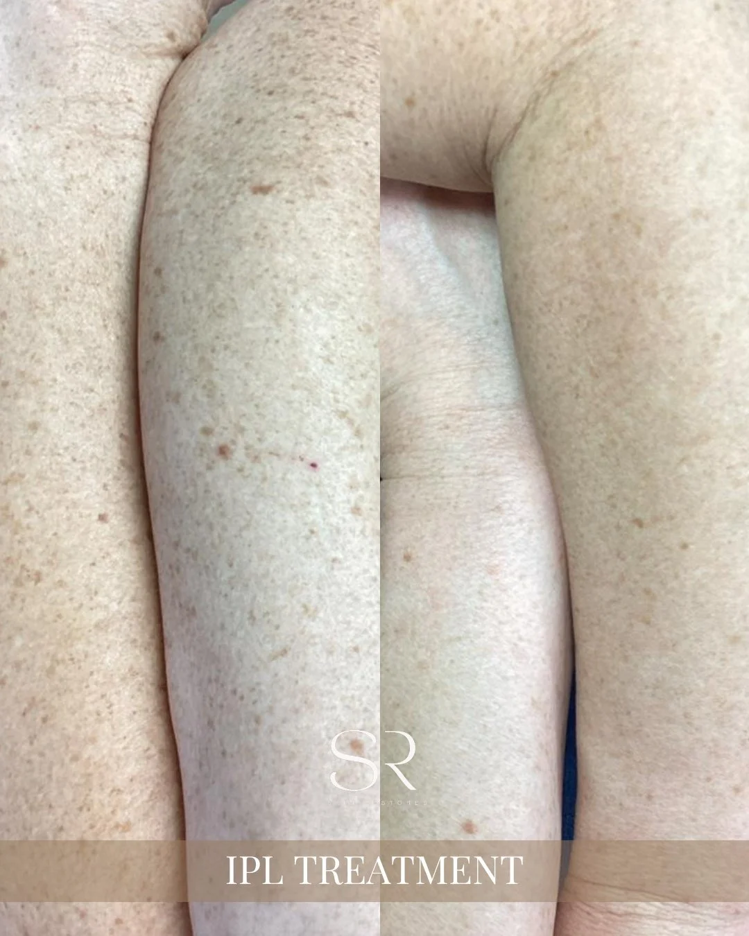 Did you know most sun spots are caused by UV exposure over time? These dark spots and uneven pigmentation appear when your skin produces extra melanin to protect itself from the sun.

Our IPL Treatment targets these pigmented areas, helping to even o