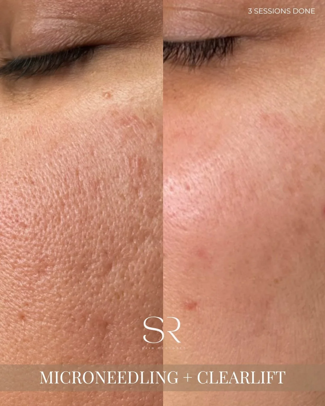Smoother, brighter, more even skin in just a few sessions!

Combining Microneedling + Clearlift targets acne scars, texture, and pigmentation while stimulating collagen production. The result? Skin that feels renewed, refreshed, and radiant from the 