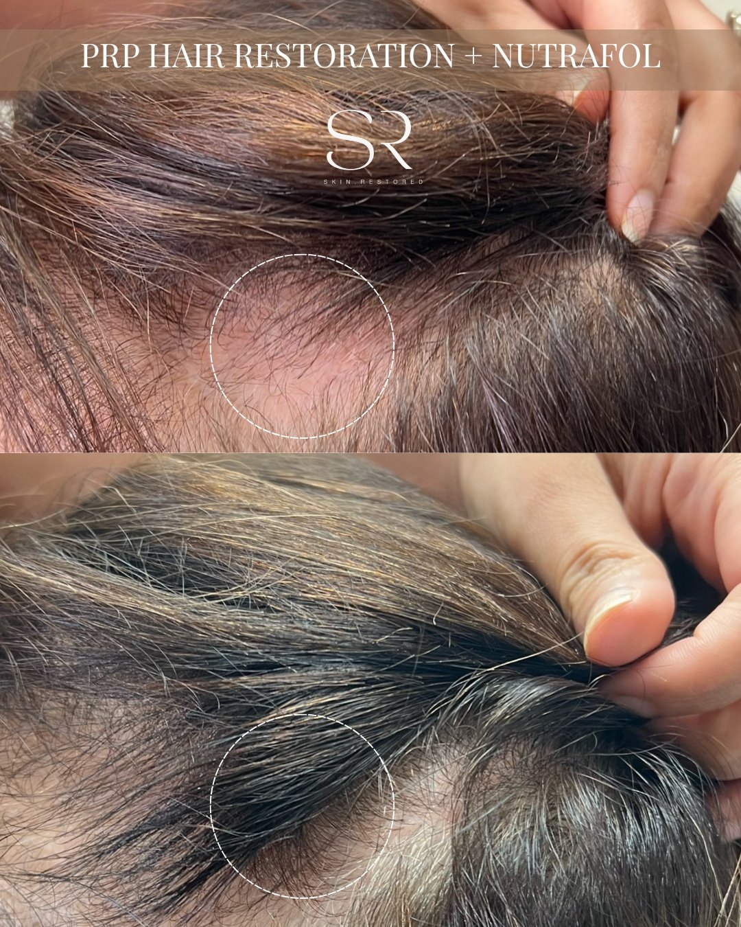 Thicker, healthier hair starts at the root! 🌟

This combination of PRP Hair Restoration + Nutrafol nourishes your follicles, strengthens growth, and helps restore hair naturally. Noticeable improvements appear with each session for fuller, stronger 