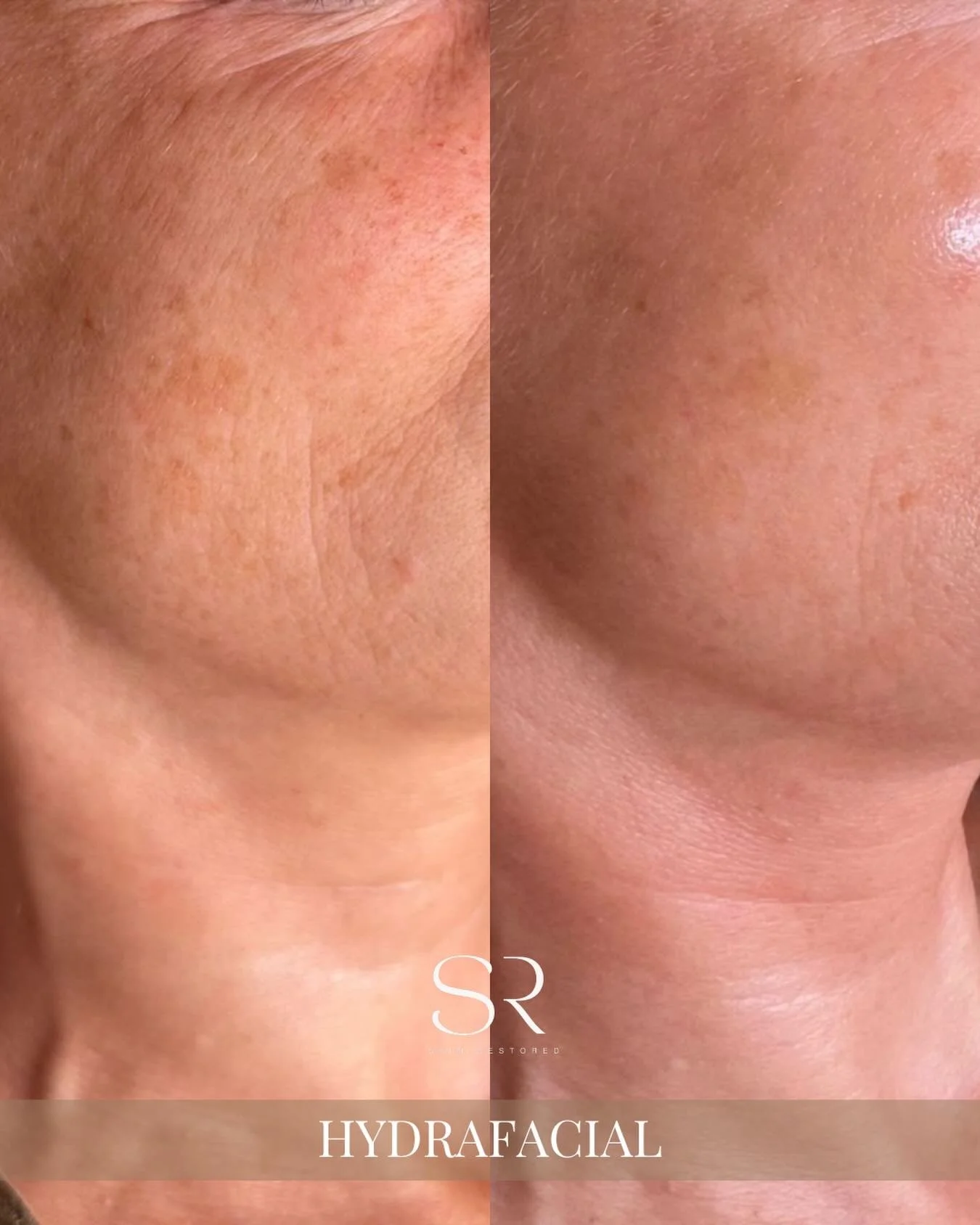 Did you know Hydrafacial does more than just hydrate? By combining gentle exfoliation, extraction, and infusion of hydrating serums, it helps smooth fine lines, plump the skin, and improve overall texture.

The treatment stimulates skin renewal, leav