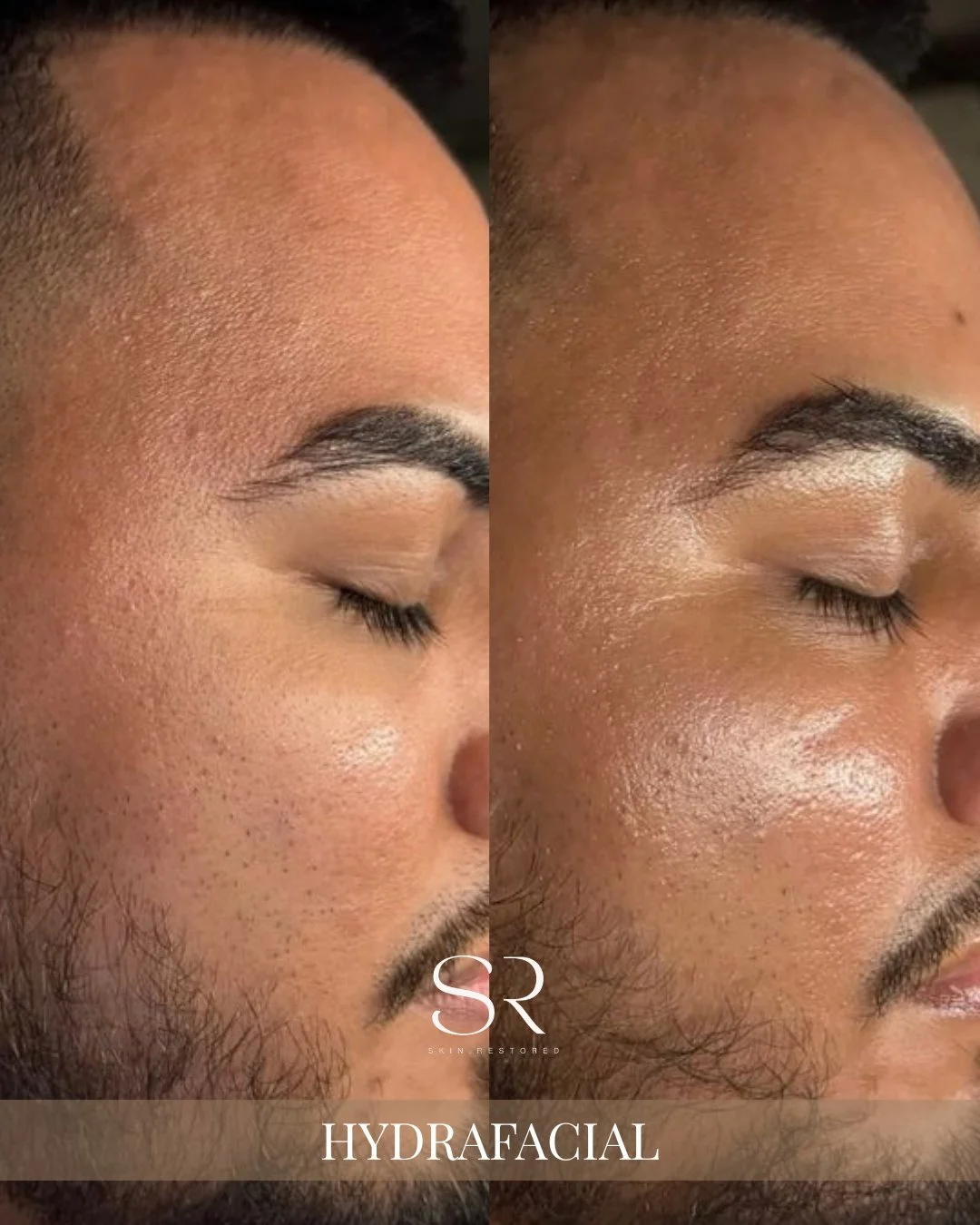 Treat Dad to the Glow He Deserves!

This Father&rsquo;s Day, help him take a moment for himself with a Hydrafacial. Smooth, refreshed skin isn&rsquo;t just for moms, men deserve it too! Our Hydrafacial detoxifies, hydrates, and reduces the appearance
