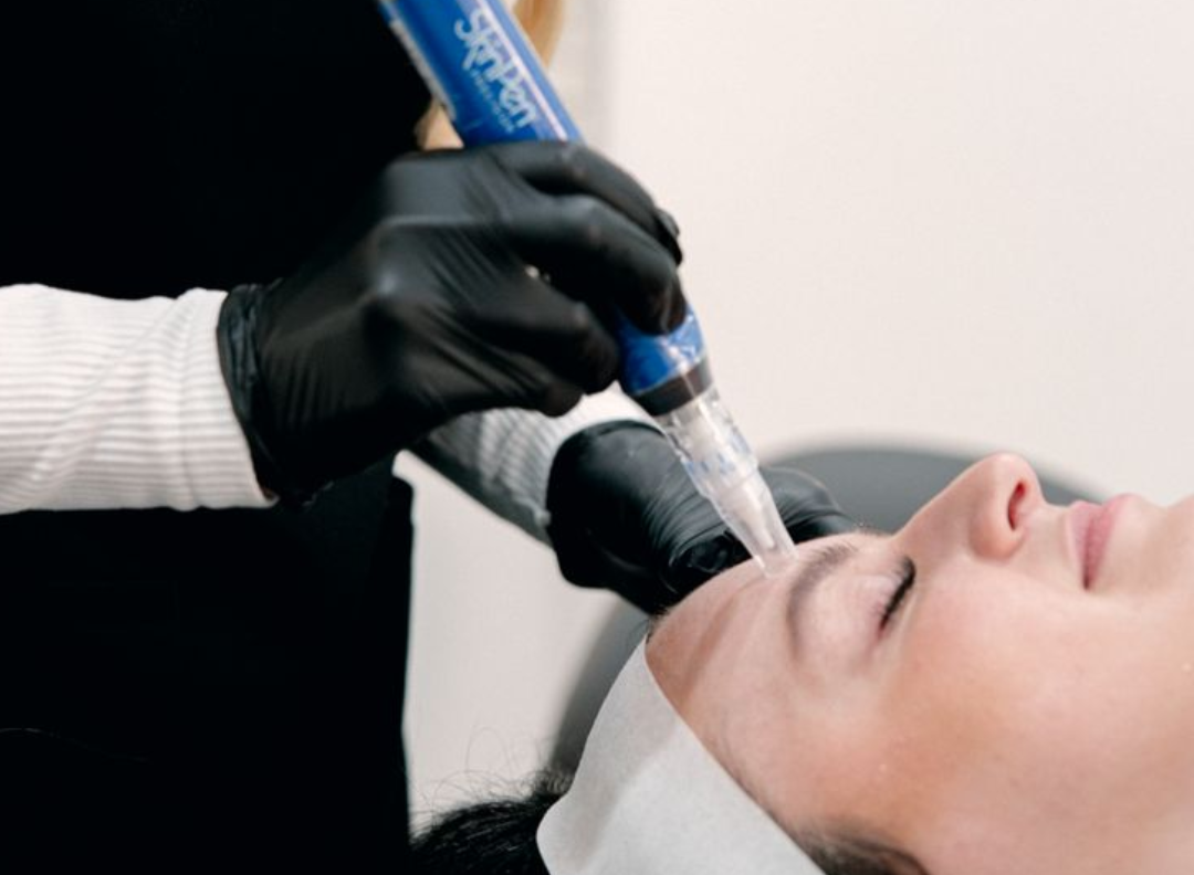 Microneedling in Fresno: What to Expect Before and After Treatment