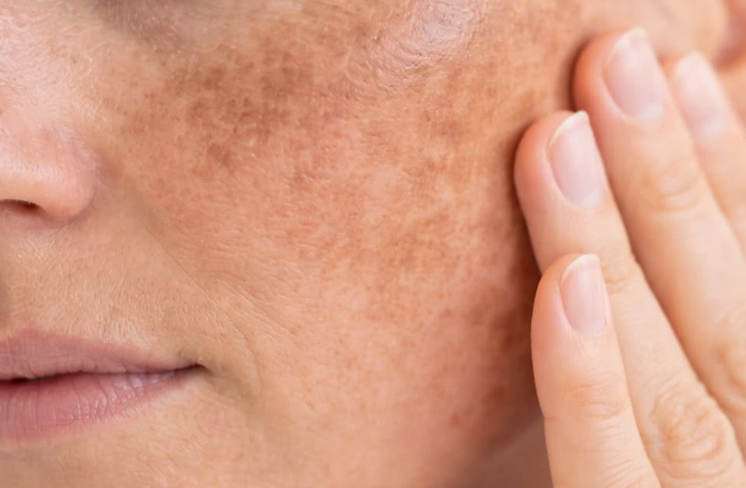 How to Treat Hyperpigmentation in Fresno's Sunny Climate