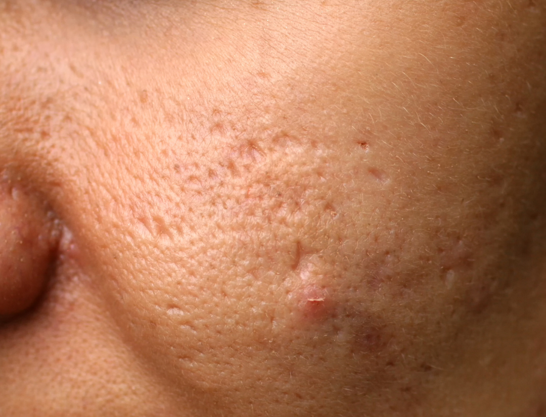 Acne Scar Treatment Fresno: What Are Your Options?