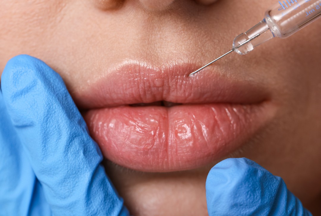 Lip Flip vs. Lip Filler in Fresno: Which Treatment is Right for You?