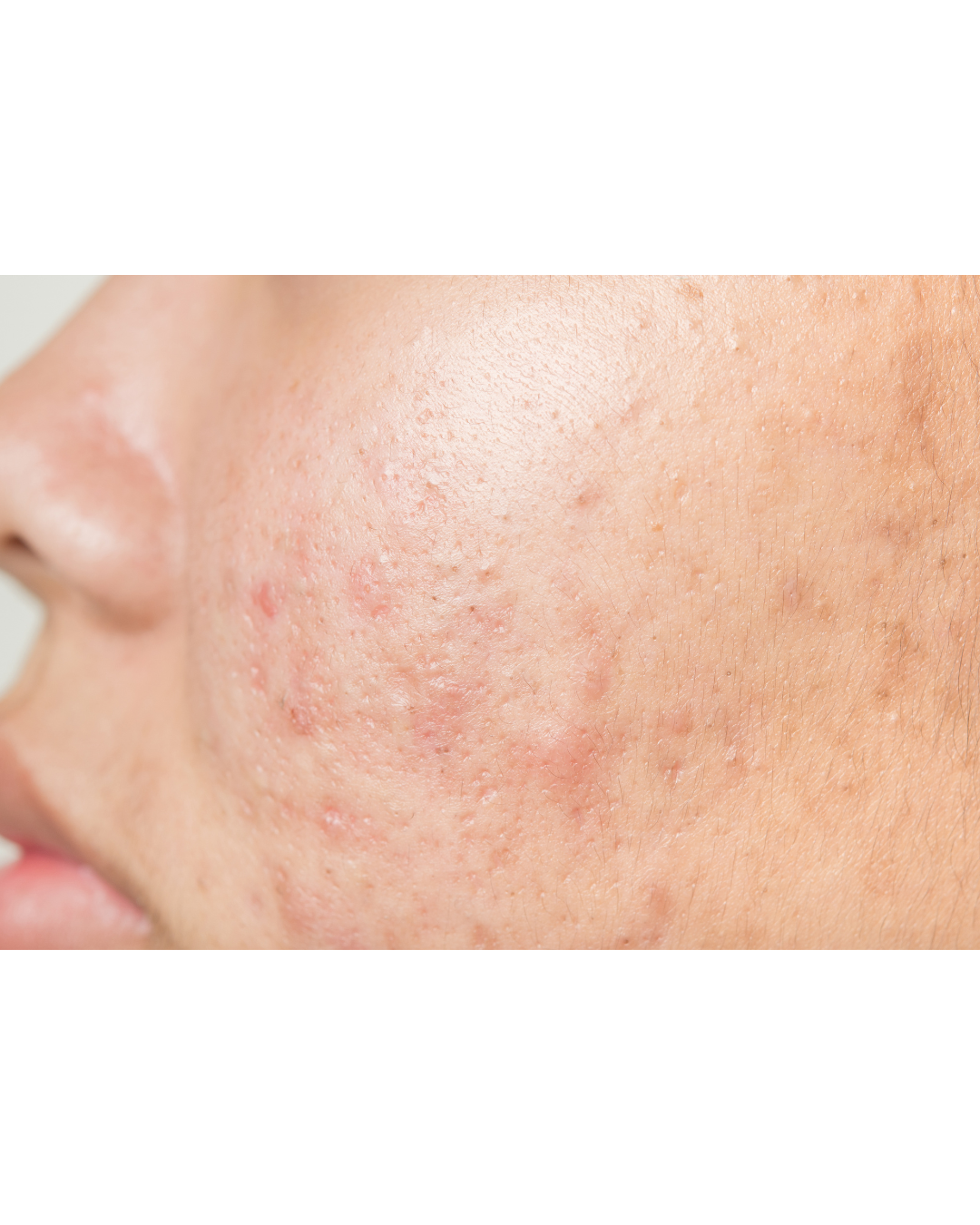 Acne Scars vs. Dark Spots: What’s the Difference?
