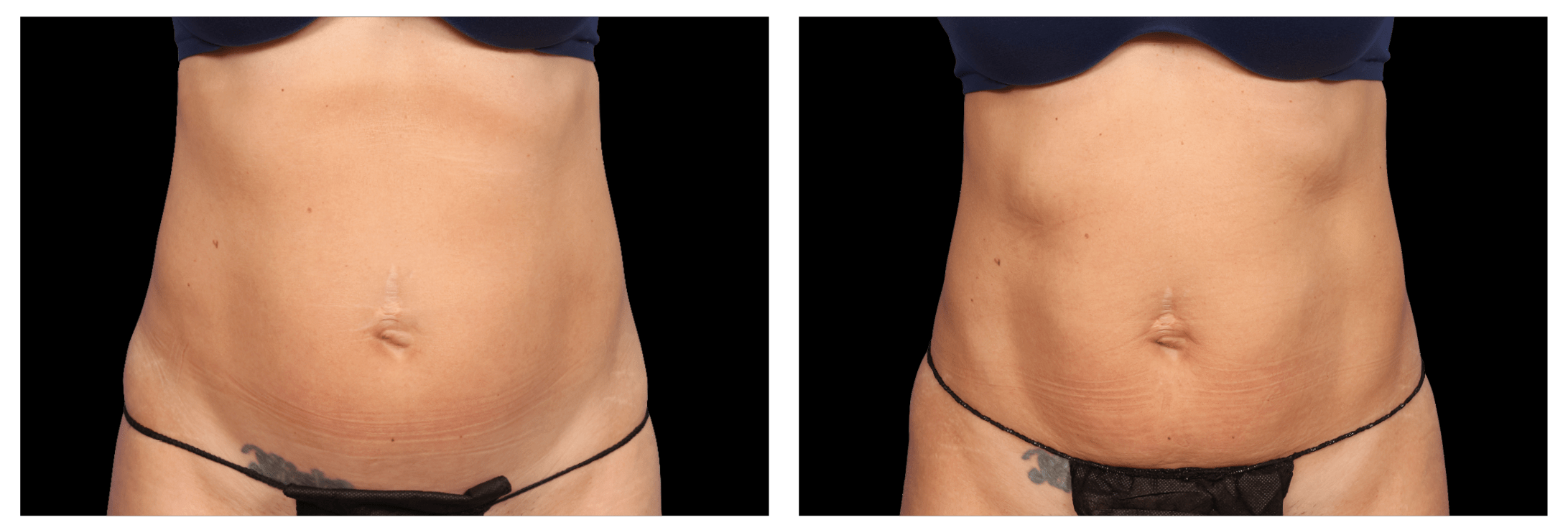 Emsculpt Nantucket (3).png