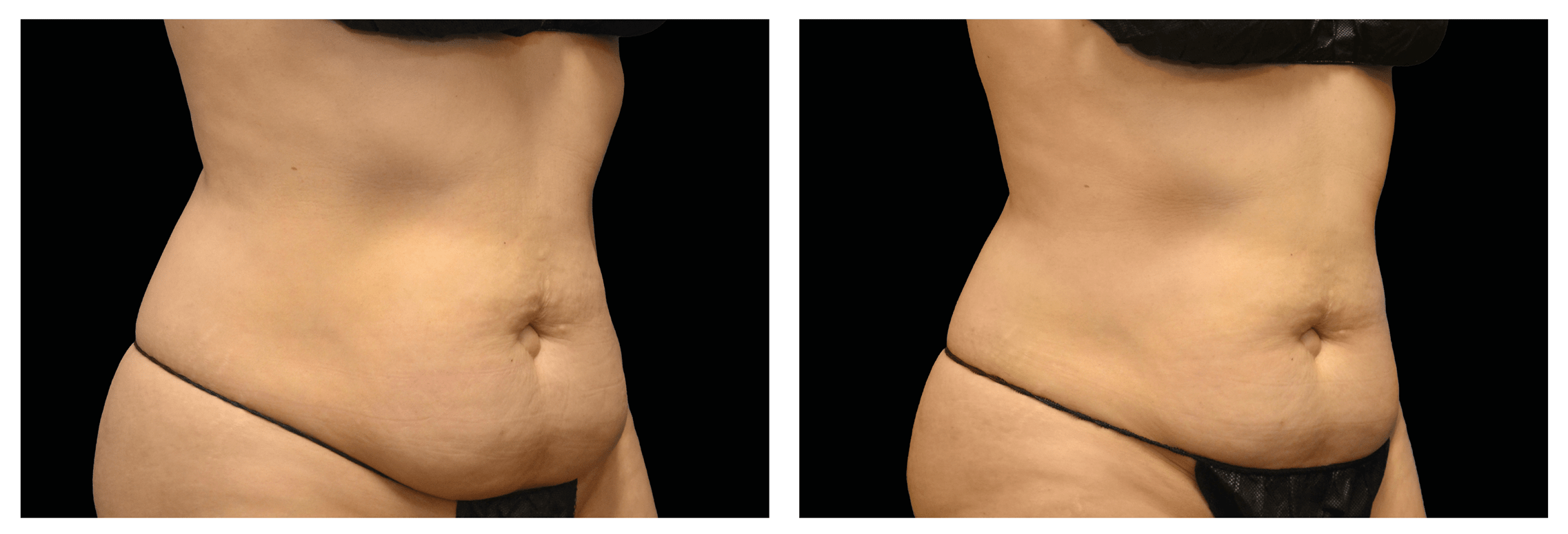 Emsculpt Nantucket (4).png