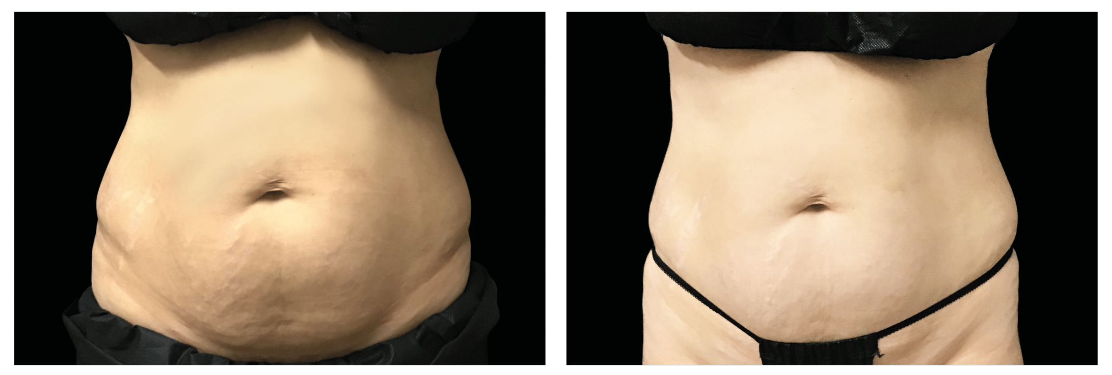Emsculpt Nantucket (9).png