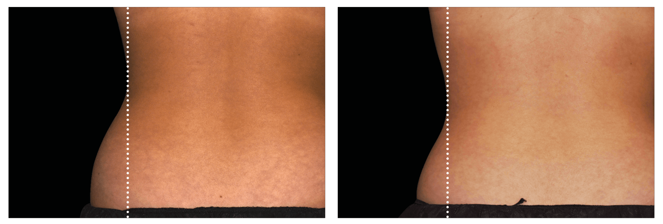 Emsculpt Nantucket (5).png