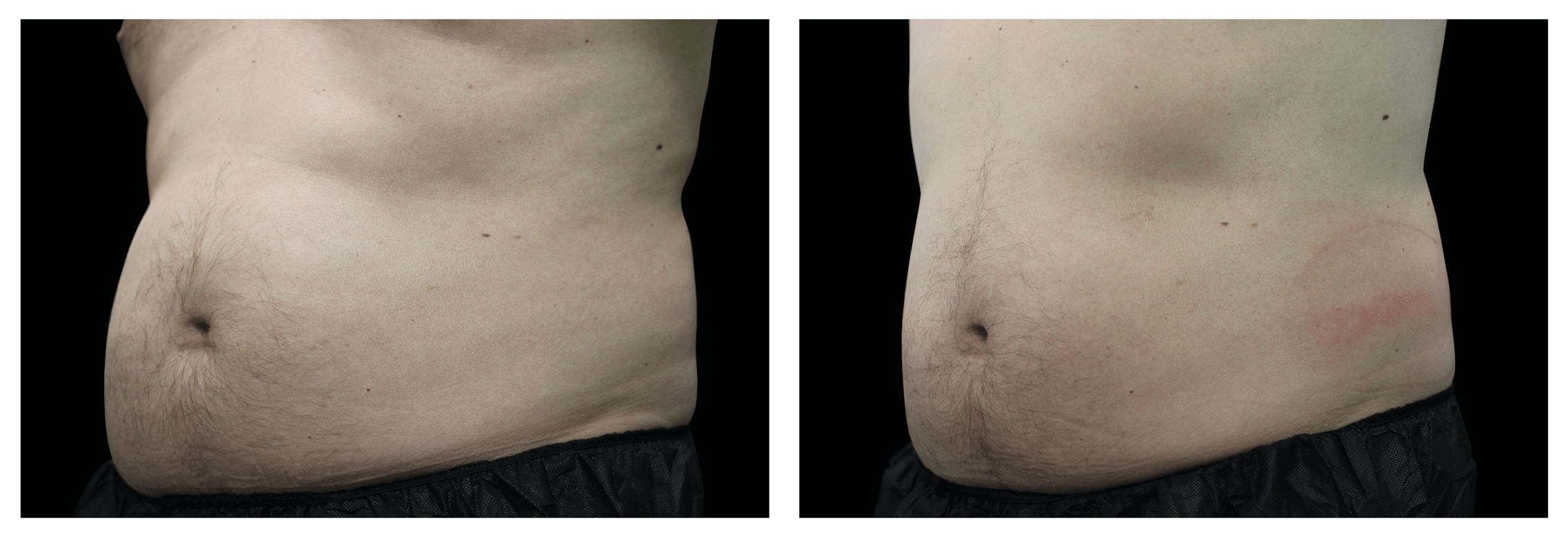 Emsculpt Nantucket (8).png
