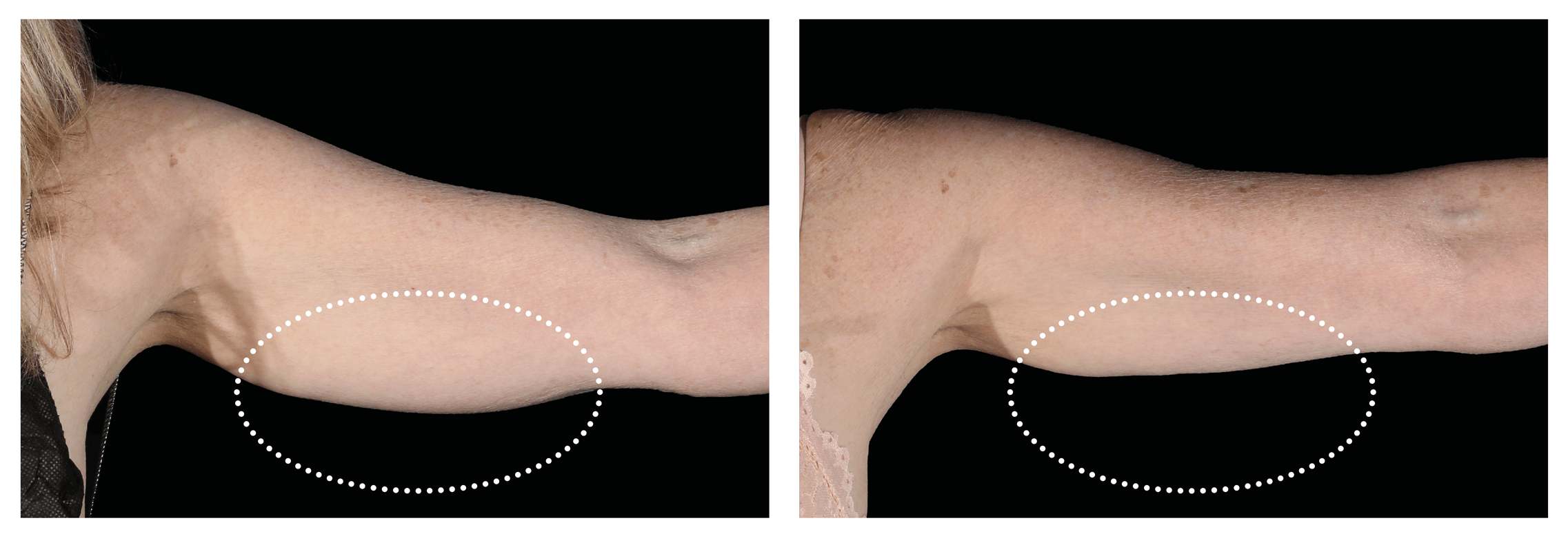 Emsculpt Nantucket (1).png