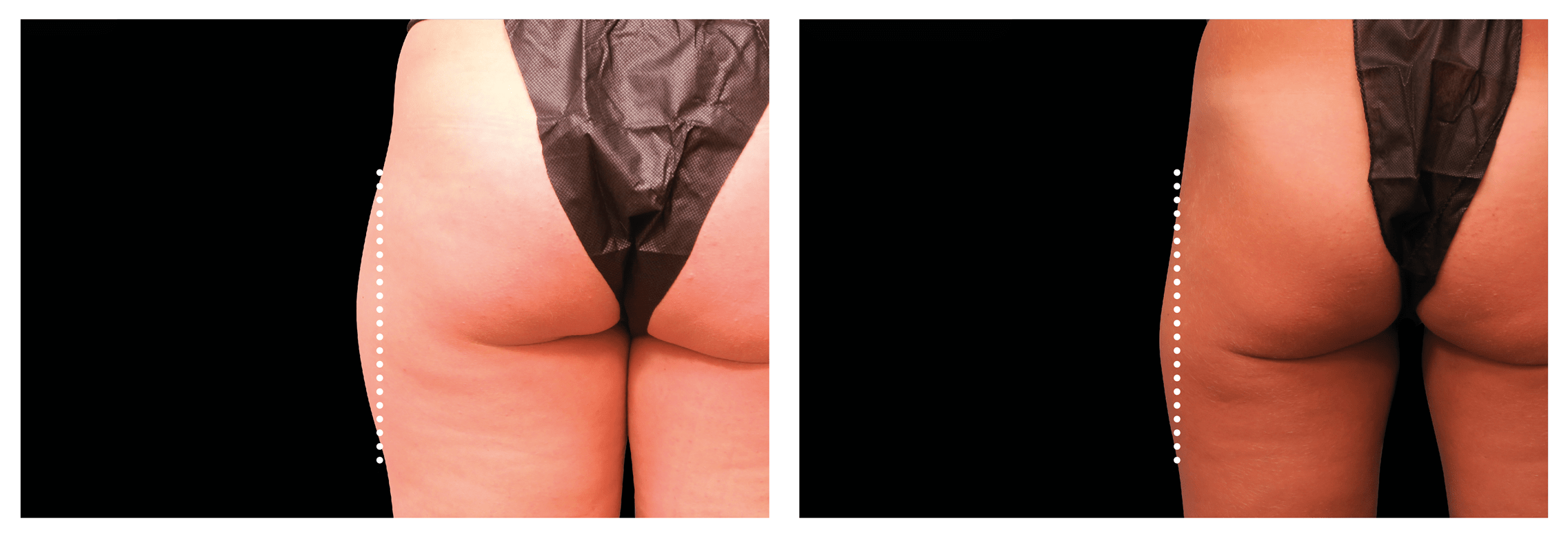 Emsculpt Nantucket (6).png