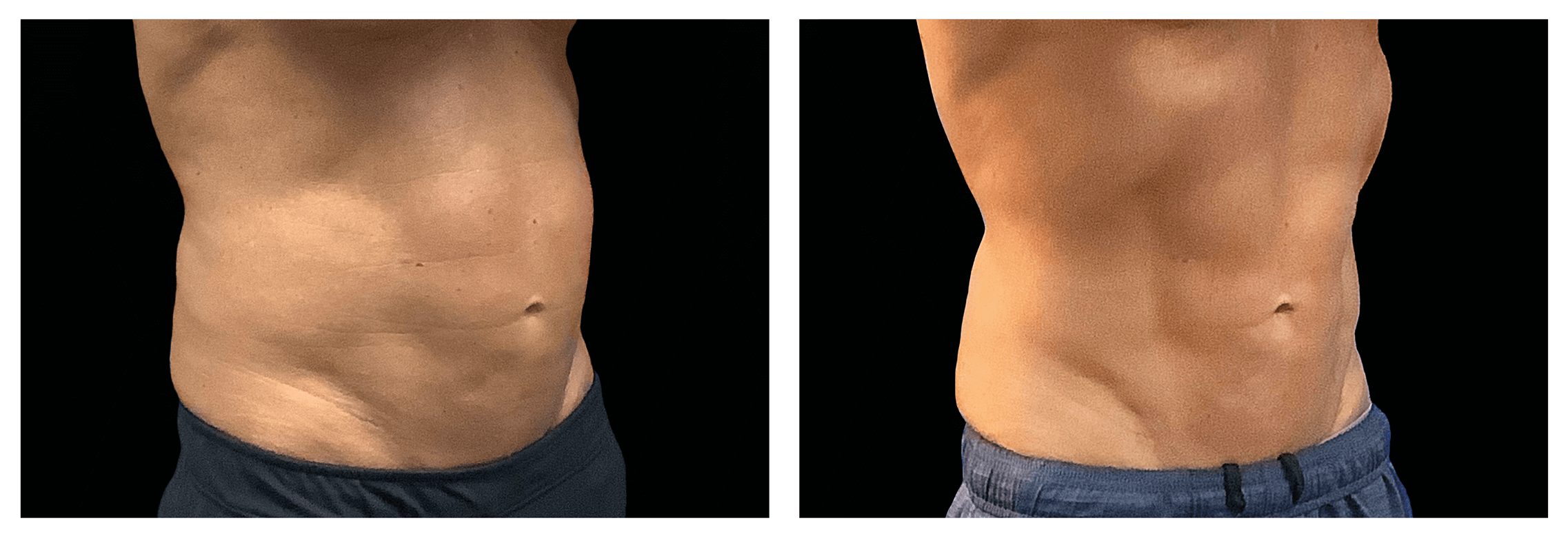 Emsculpt Nantucket (12).png