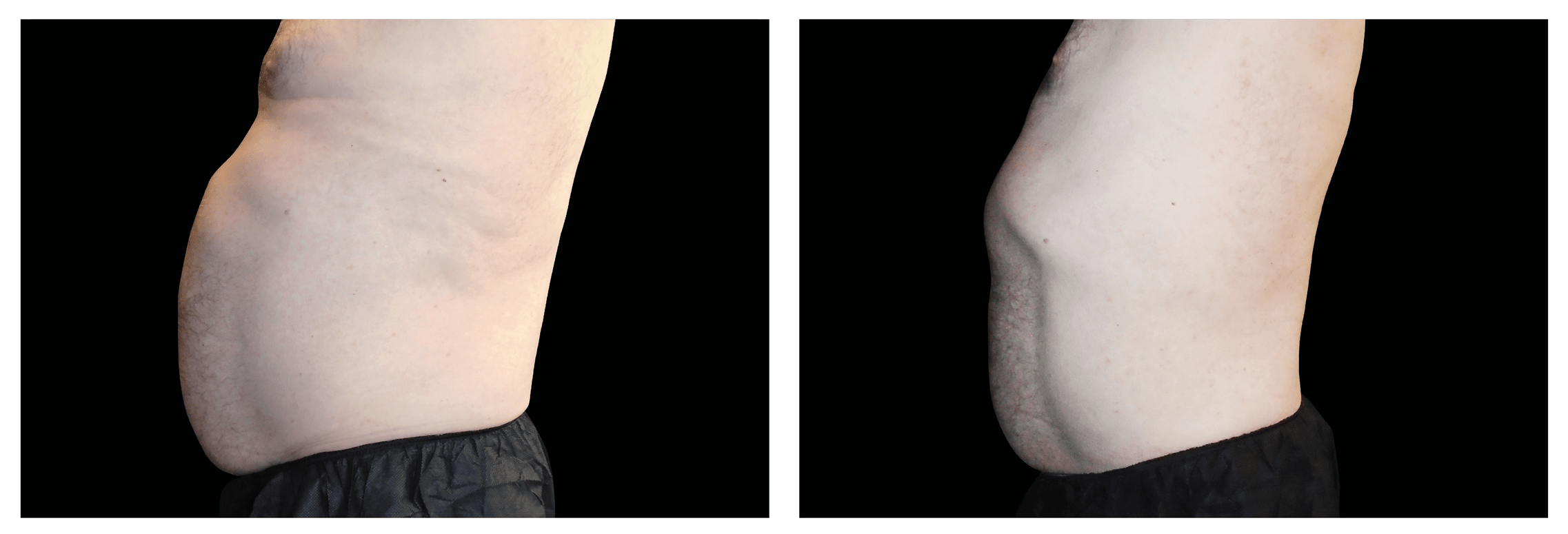 Emsculpt Nantucket (11).png