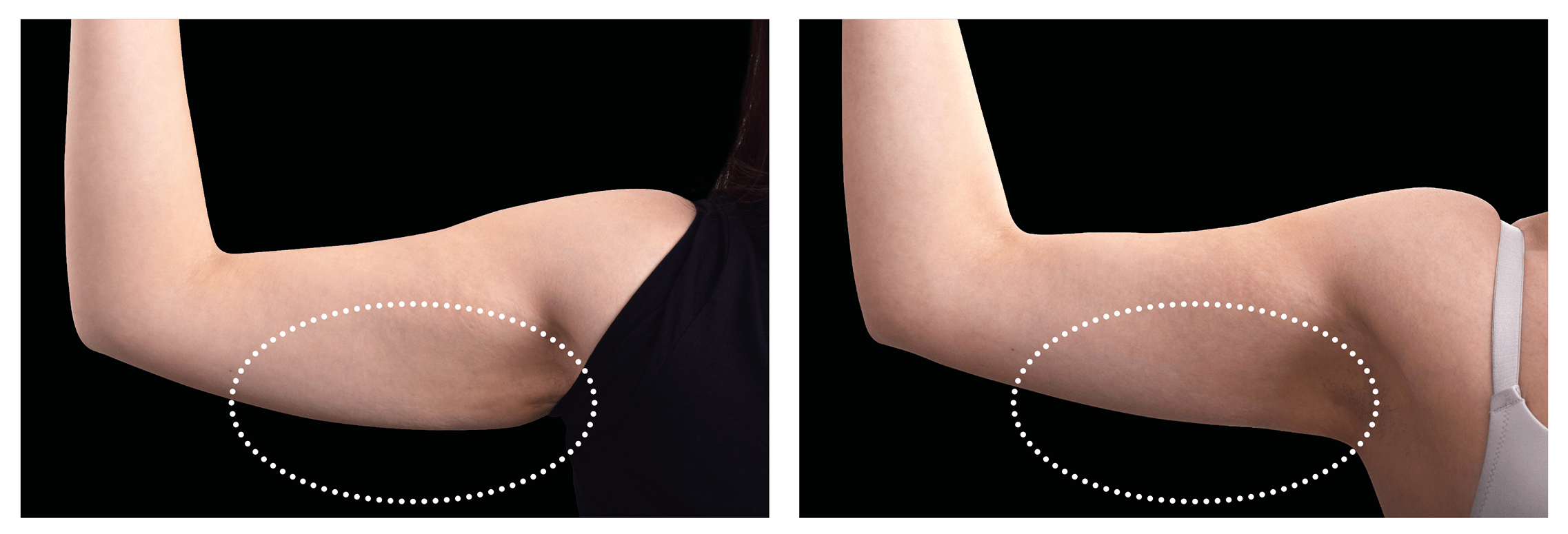 Emsculpt Nantucket (2).png