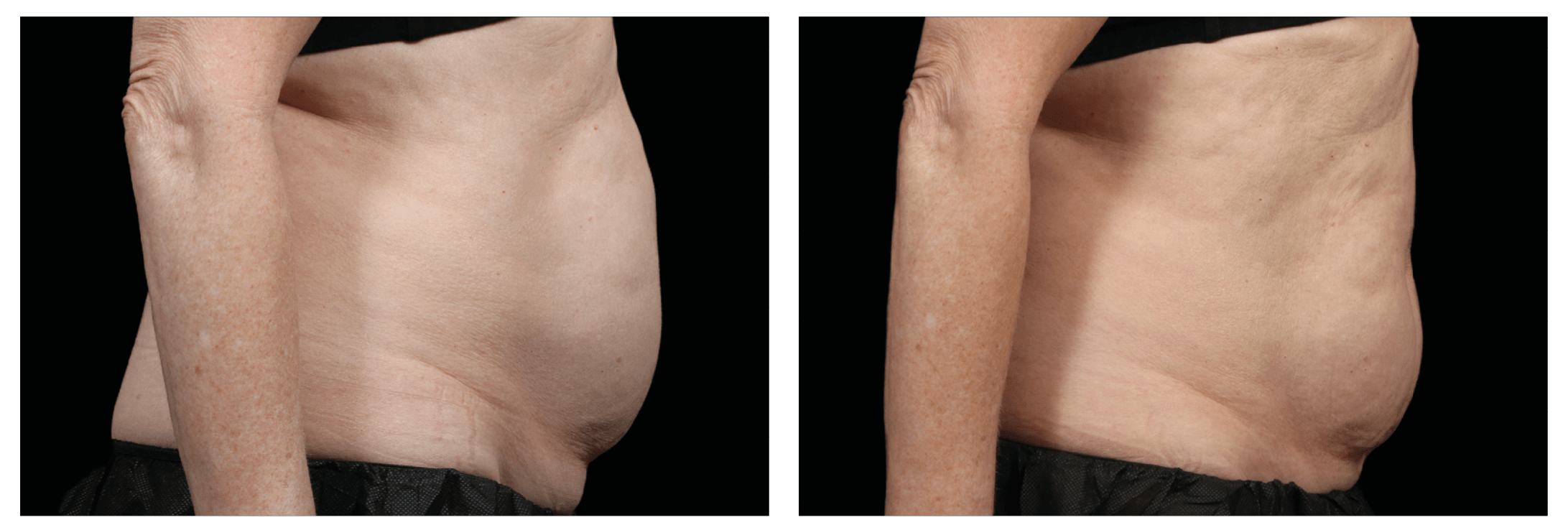 Emsculpt Nantucket (10).png