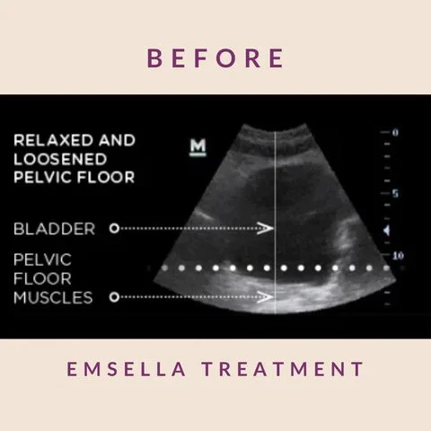 Incontinence Treatment