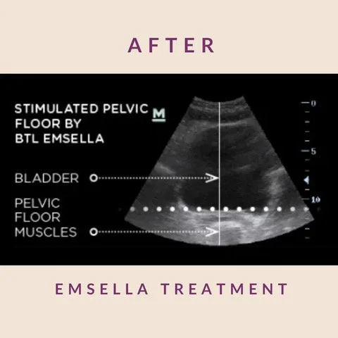 Incontinence Treatments Nantucket MA