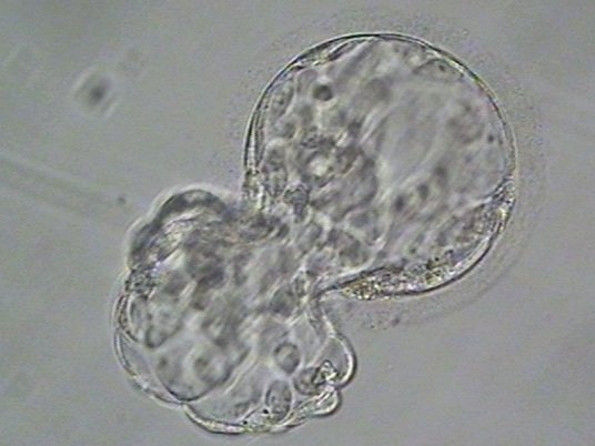 Fresh Embryo Transfers: The Pros and Cons