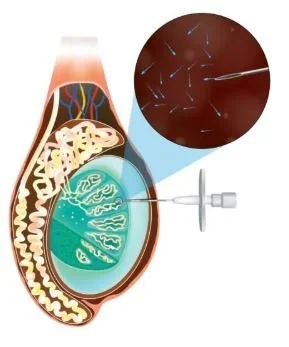 What are TESE, TESA, MicroTESE, MESA, and PESA? Sperm Extraction Methods for IVF