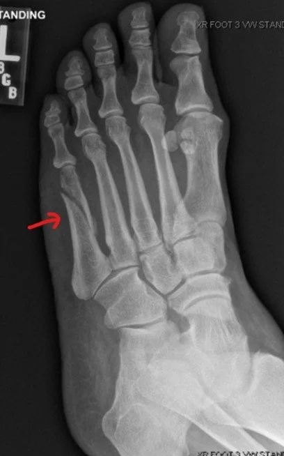 Fractured foot Guide