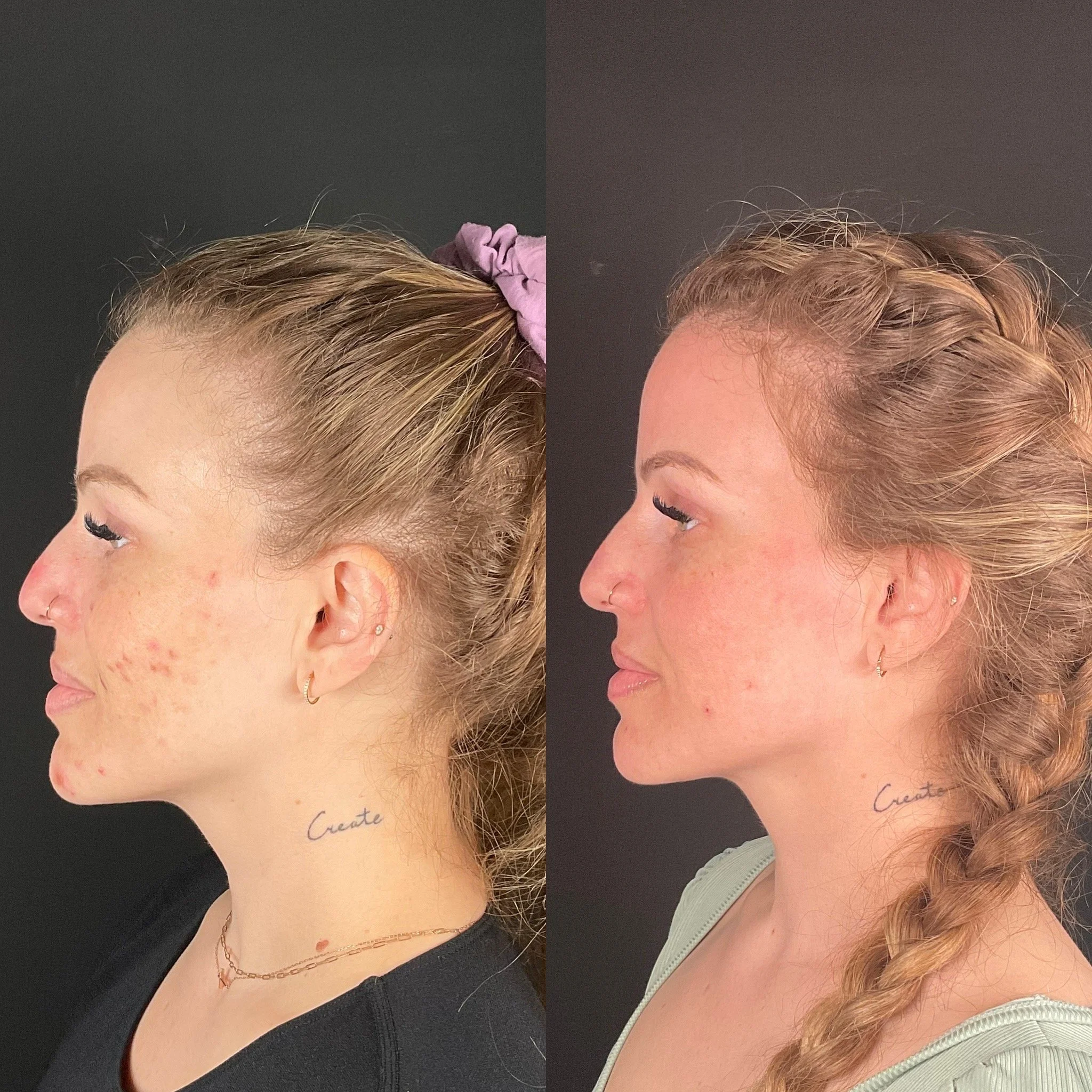 C02 Laser Resurfacing Treatment {Cool Peel} cntd.