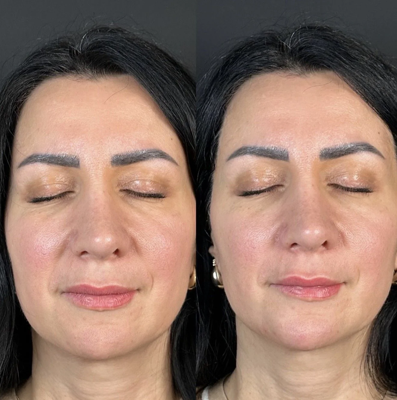 Lower face | Chin and jawline filler