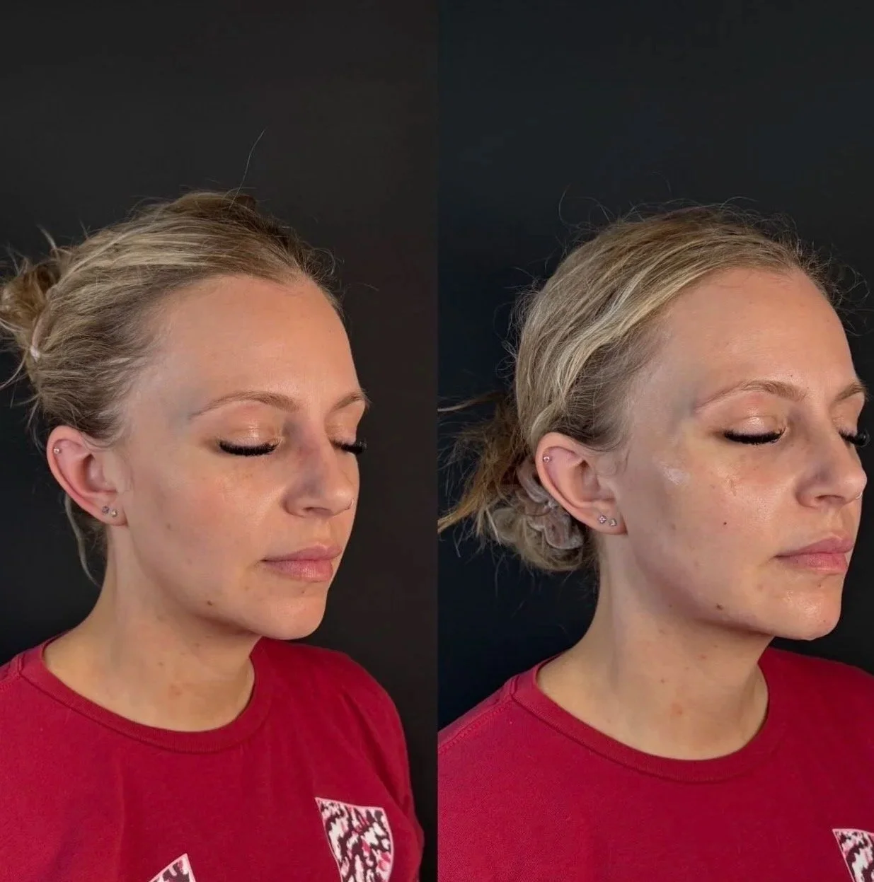 Youthful You Glam Package | Cheek, chin, and jawline enhancement 