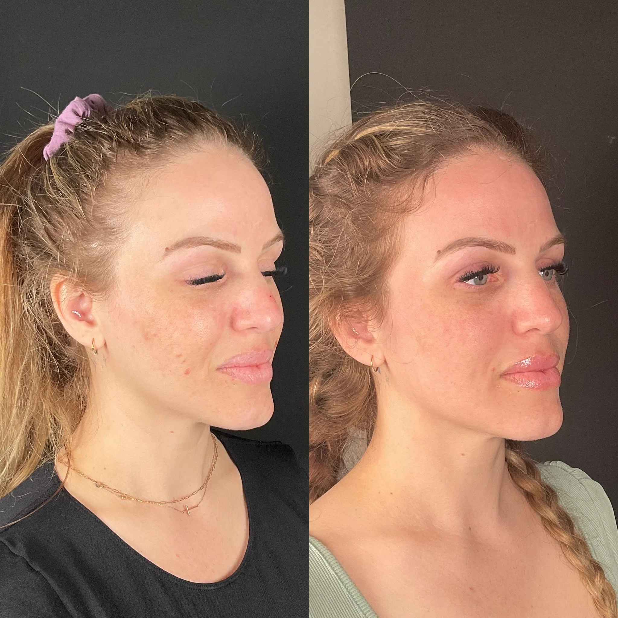 C02 Laser Resurfacing Treatment {Cool Peel}