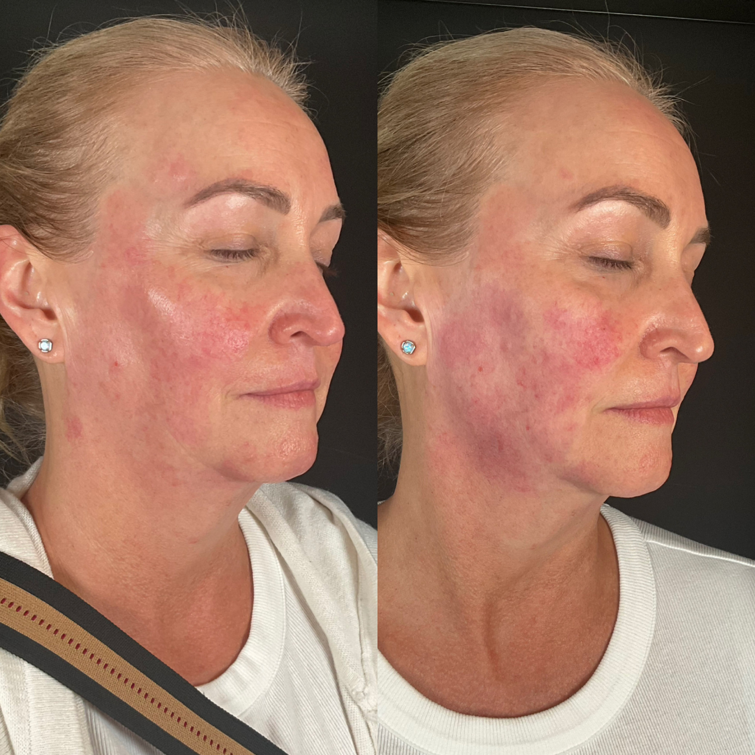 Cheek Filler + SkinVive