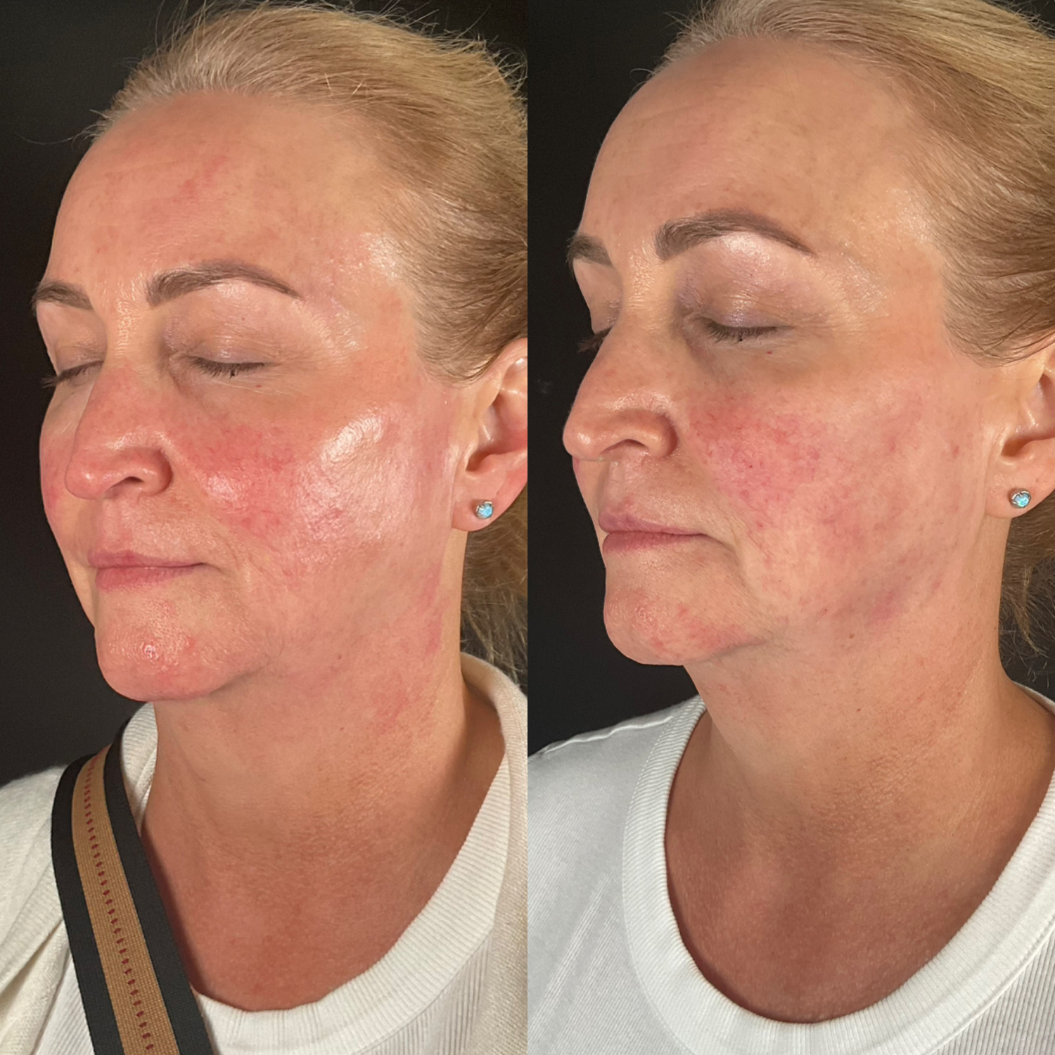 Cheek Filler + SkinVive cntd.
