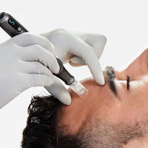 Microneedling