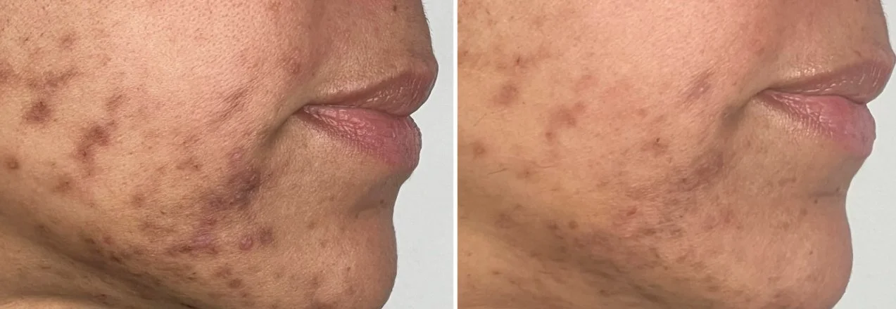 Before and after 12 weeks of peel treatment and a comprehensive home-care regimen.