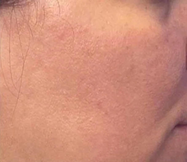 One week after the chemical peel