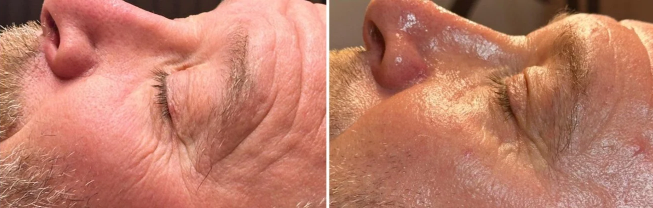 Before and after 12 weeks of SWiCH, microneedling, chemical peel treatments, and a comprehensive home-care regimen.